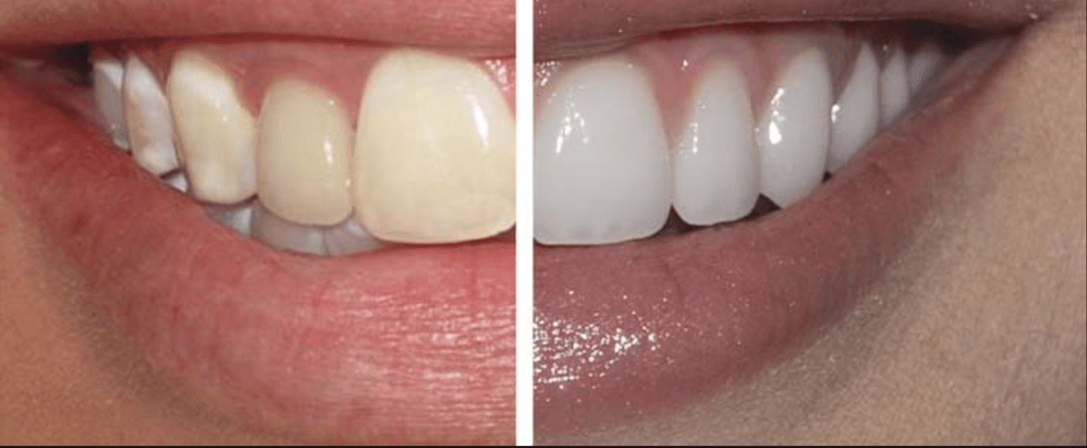 8 Important Things about Veneers Near Me